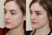 Rhinoplasty Surgery. 1 year post-op.