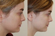 Rhinoplasty Surgery. 1 year post-op.