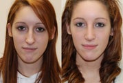 Rhinoplasty Surgery. 1 month post-op