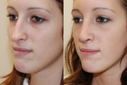 Rhinoplasty Surgery. 1 month post-op.