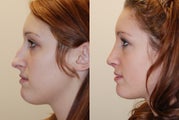 Rhinoplasty Surgery. 1 month post-op.