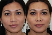 Rhinoplasty Surgery. Front view. 7-months post-op.