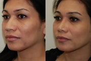 Rhinoplasty Surgery. Oblique view. 7-months post-op.