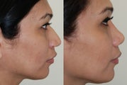 Rhinoplasty Surgery. Profile view. 7-months post-op.