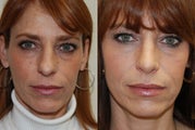 Rhinoplasty Surgery. 3 mos. post-op.