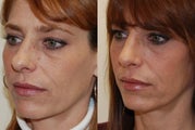 Rhinoplasty Surgery. 3 mos. post-op.