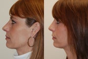 Rhinoplasty Surgery. 3 mos. post-op.