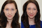 Rhinoplasty Surgery. 4 months post-op.