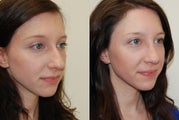 Rhinoplasty Surgery. 4 months post-op.