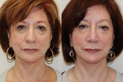 Rhinoplasty Surgery. 6 months post-op
