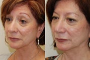 Rhinoplasty Surgery. 6 months post-op.