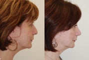 Rhinoplasty Surgery. 6 months post-op.