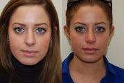 Rhinoplasty Surgery. 1 month post-op.