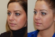 Rhinoplasty Surgery. 1 month post-op.