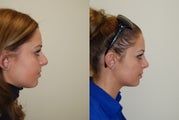 Rhinoplasty Surgery. 1 month post-op.