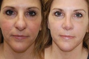 Rhinoplasty Surgery. 2 months post-op