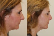 Rhinoplasty Surgery. 2 months post-op.
