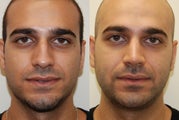 Rhinoplasty Surgery. 3 years post-op.