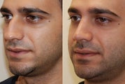 Rhinoplasty Surgery. 3 years post-op.