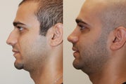 Rhinoplasty Surgery. 3 years post-op.