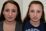 Rhinoplasty Surgery. 4 months post-op.
