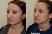 Rhinoplasty Surgery. 4 months post-op