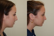 Rhinoplasty Surgery. 4 months post-op.