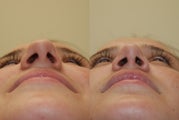 Rhinoplasty Surgery. 4 months post-op.