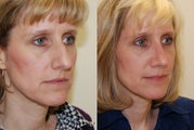 Rhinoplasty Surgery. 3 months post-op.