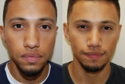 Rhinoplasty Surgery. 1 month post-op