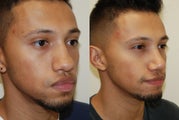 Rhinoplasty Surgery. 1 month post-op.