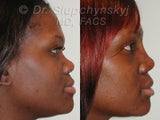 African American Rhinoplasty Revision