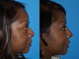 Ethnic Rhinoplasty