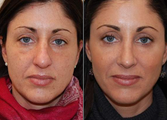 Rhinoplasty and IPL PhotoFacial