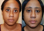 Rhinoplasty with bridge implant and chin implant