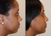 Rhinoplasty with bridge implant and chin implant