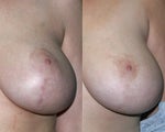 Fraxel Restore and Vbeam Perfecta treatments for Breast Surgery Scars
