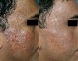 Fraxel Restore treatment of Facial Scars