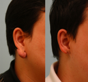 Keloid Removal