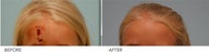 Laceration Repair