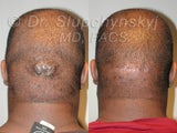 Keloid Removal