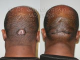 Keloid Removal