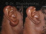 Keloid Removal
