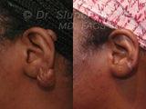 Keloid Removal