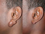 Keloid Removal