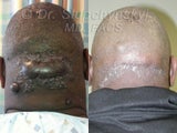 Keloid Removal
