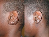 Keloid Removal