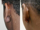 Keloid Removal