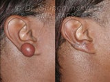 Keloid Removal