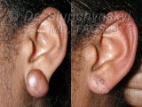 Keloid Removal